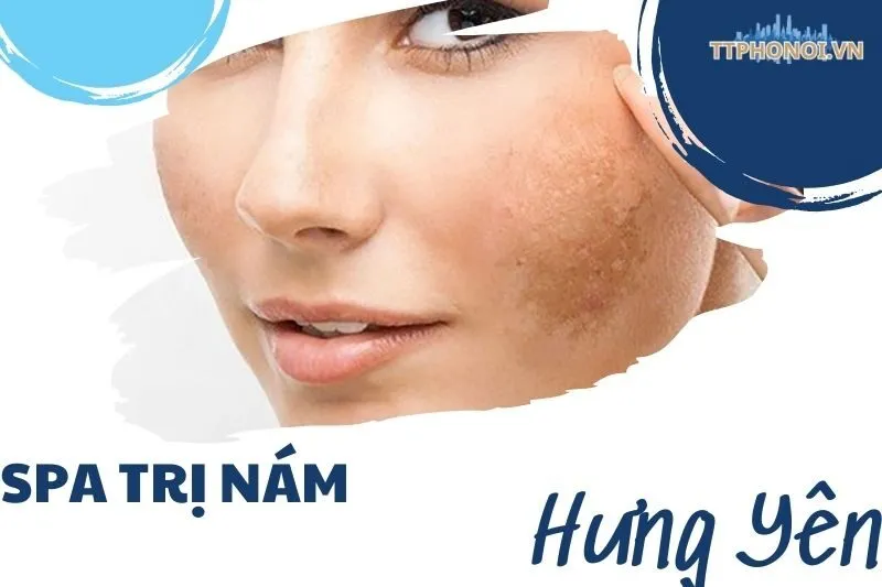 Top 8 Spa Trị Nám Hưng Yên Hiệu Quả Đáng Thử Năm 2025