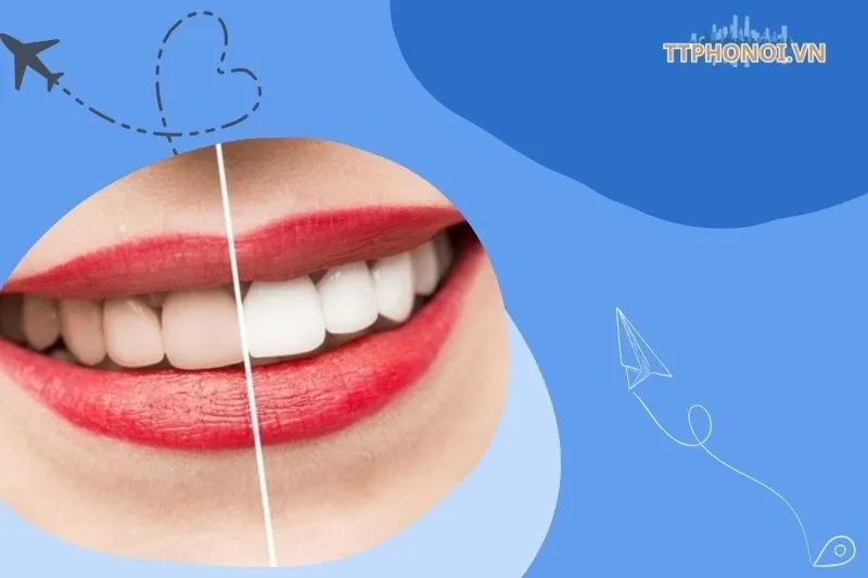 Top 6 Địa chỉ tẩy trắng răng Hưng Yên chất lượng